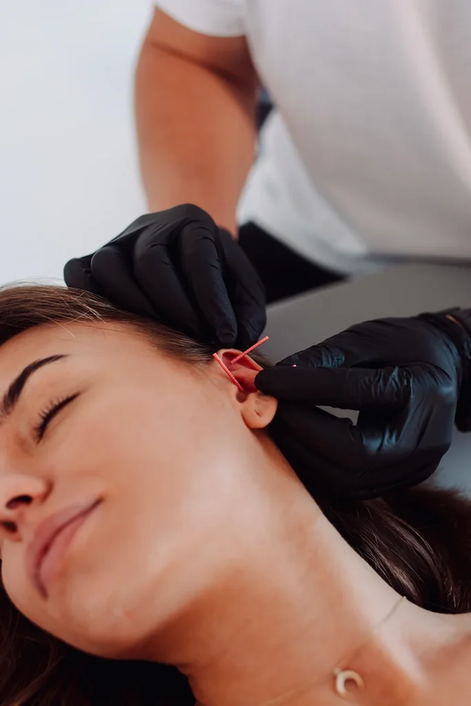 Zabieg akupunktury ucha (aurikuloterapii) w Uzdrovisko – terapeuta w czarnych rękawiczkach umieszcza igły w uchu pacjentki.