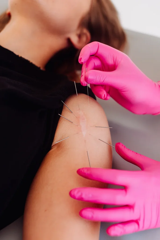 Terapia blizny metodą suchego igłowania – fizjoterapeuta w różowych rękawiczkach aplikuje igły wokół blizny na ramieniu pacjenta.
